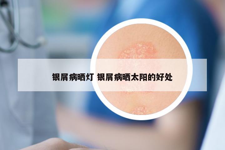 银屑病晒灯 银屑病晒太阳的好处