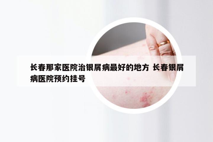 长春那家医院治银屑病最好的地方 长春银屑病医院预约挂号