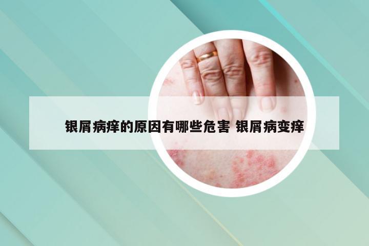 银屑病痒的原因有哪些危害 银屑病变痒