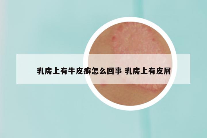 乳房上有牛皮癣怎么回事 乳房上有皮屑