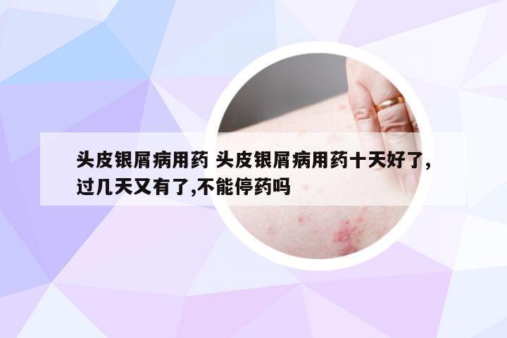 头皮银屑病用药 头皮银屑病用药十天好了,过几天又有了,不能停药吗