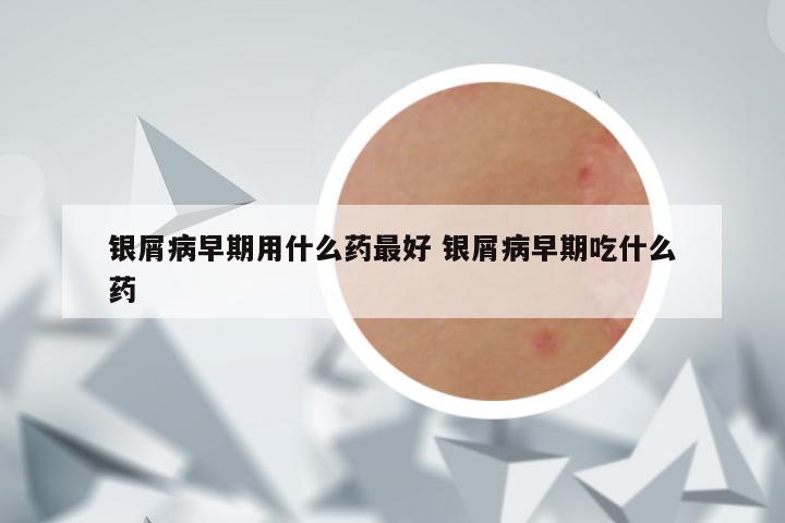 银屑病早期用什么药最好 银屑病早期吃什么药