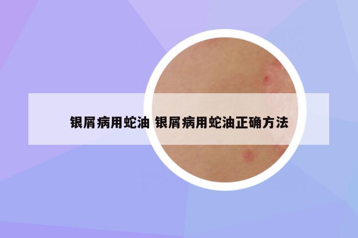 银屑病用蛇油 银屑病用蛇油正确方法