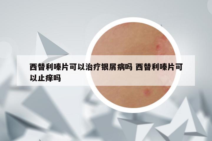 西替利嗪片可以治疗银屑病吗 西替利嗪片可以止痒吗