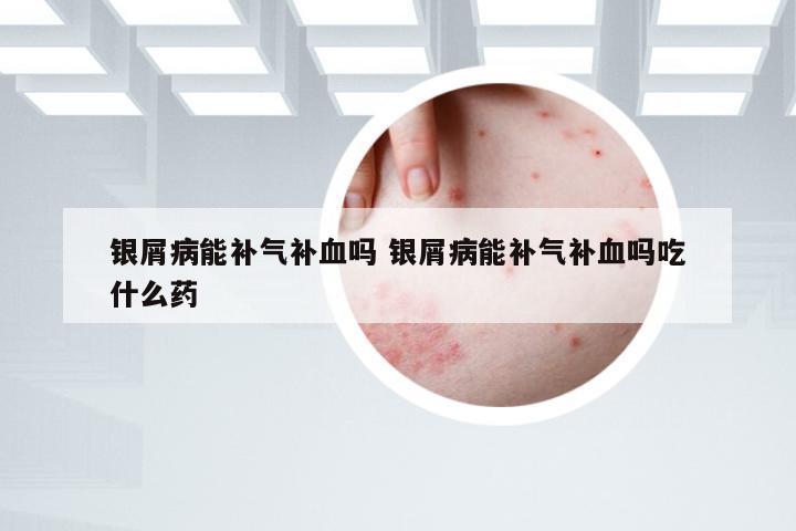 银屑病能补气补血吗 银屑病能补气补血吗吃什么药