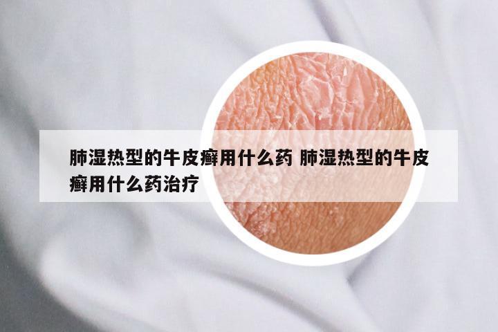 肺湿热型的牛皮癣用什么药 肺湿热型的牛皮癣用什么药治疗