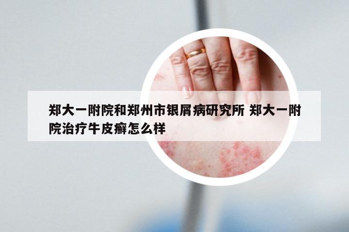 郑大一附院和郑州市银屑病研究所 郑大一附院治疗牛皮癣怎么样