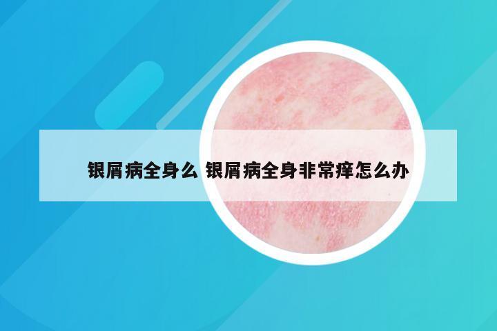 银屑病全身么 银屑病全身非常痒怎么办