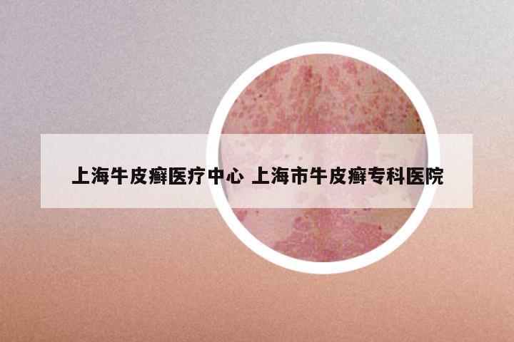 上海牛皮癣医疗中心 上海市牛皮癣专科医院