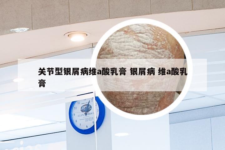 关节型银屑病维a酸乳膏 银屑病 维a酸乳膏