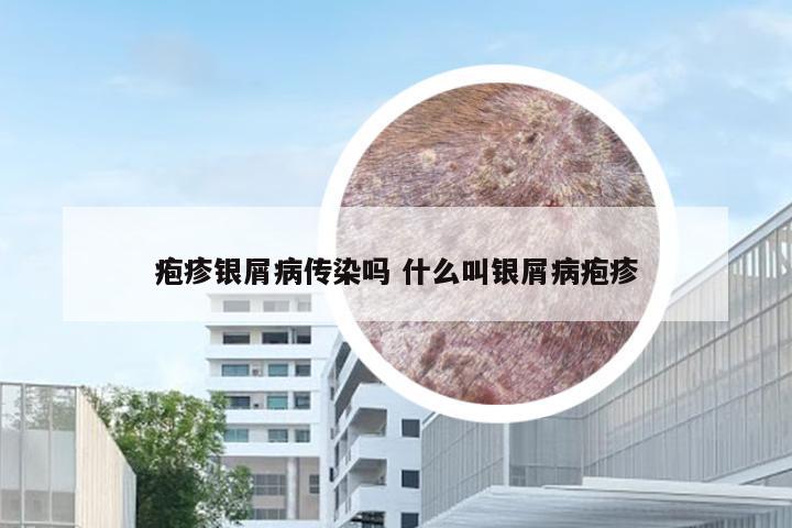 疱疹银屑病传染吗 什么叫银屑病疱疹