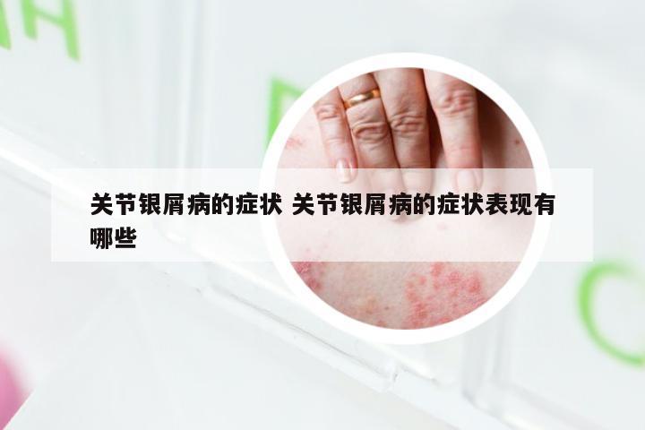关节银屑病的症状 关节银屑病的症状表现有哪些