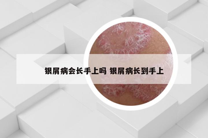 银屑病会长手上吗 银屑病长到手上