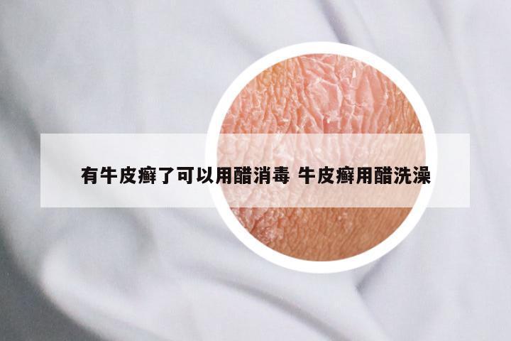 有牛皮癣了可以用醋消毒 牛皮癣用醋洗澡