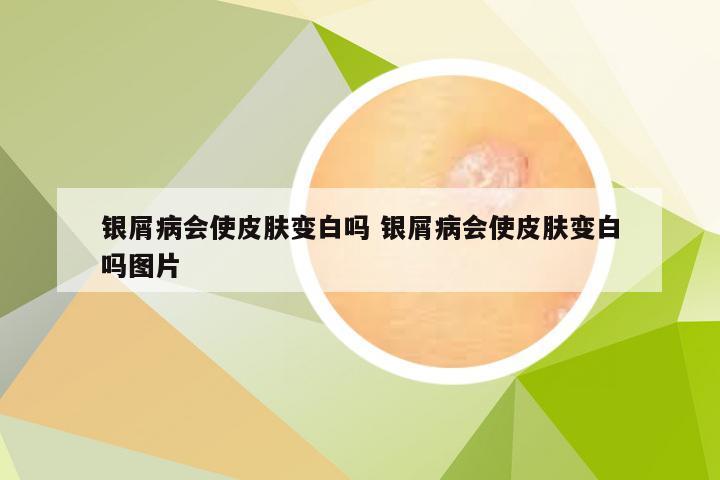 银屑病会使皮肤变白吗 银屑病会使皮肤变白吗图片