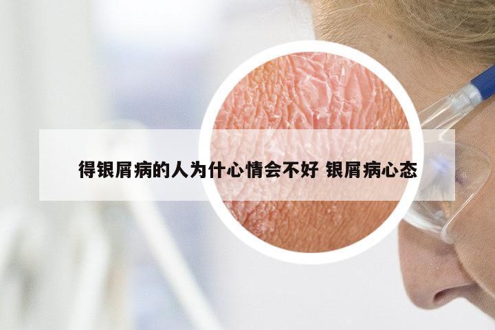得银屑病的人为什心情会不好 银屑病心态