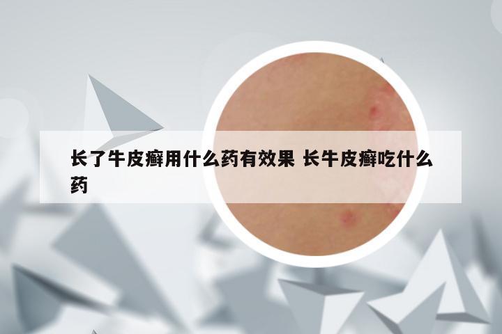 长了牛皮癣用什么药有效果 长牛皮癣吃什么药