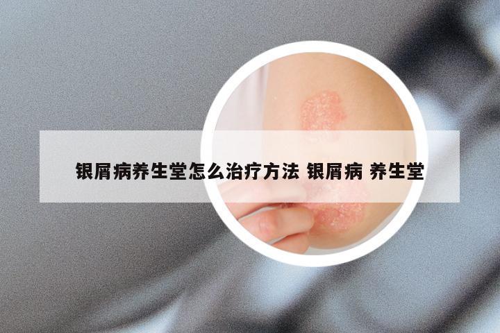 银屑病养生堂怎么治疗方法 银屑病 养生堂