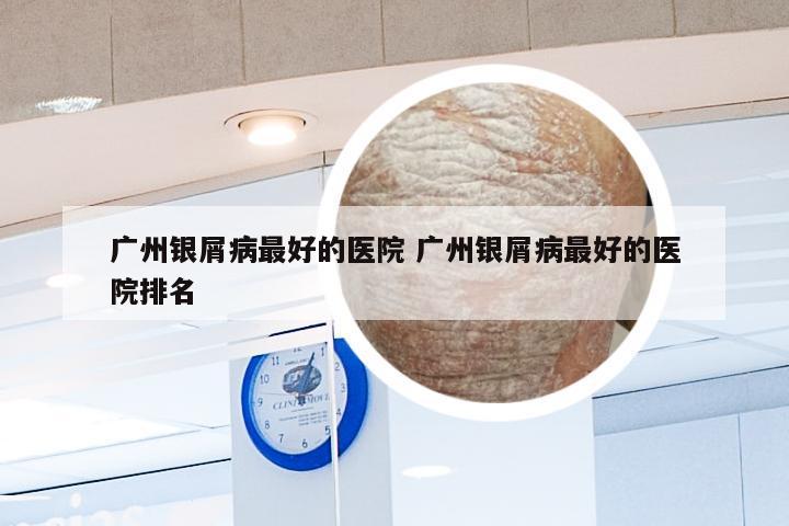 广州银屑病最好的医院 广州银屑病最好的医院排名