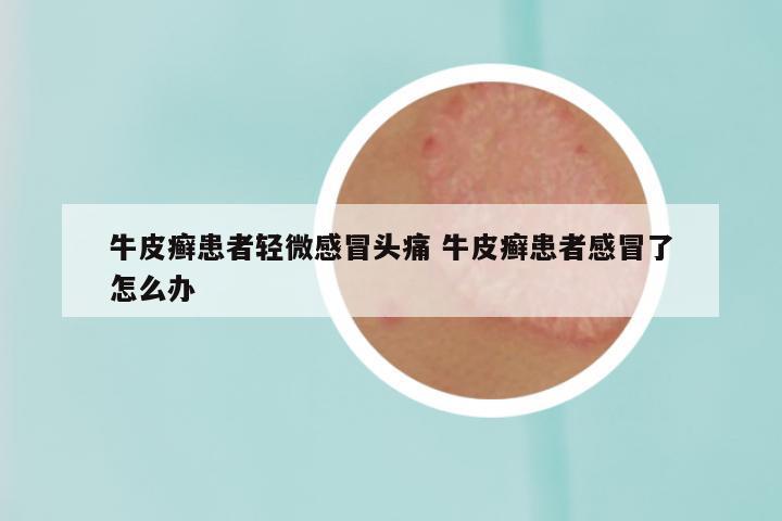 牛皮癣患者轻微感冒头痛 牛皮癣患者感冒了怎么办