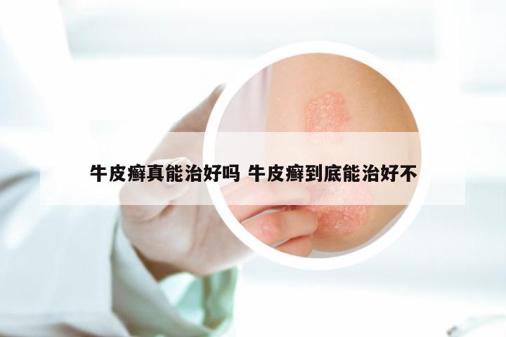牛皮癣真能治好吗 牛皮癣到底能治好不