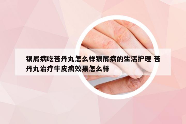 银屑病吃苦丹丸怎么样银屑病的生活护理 苦丹丸治疗牛皮癣效果怎么样