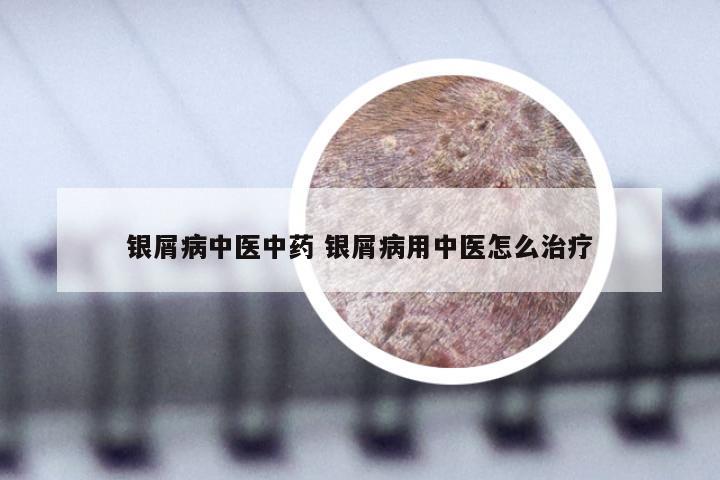 银屑病中医中药 银屑病用中医怎么治疗