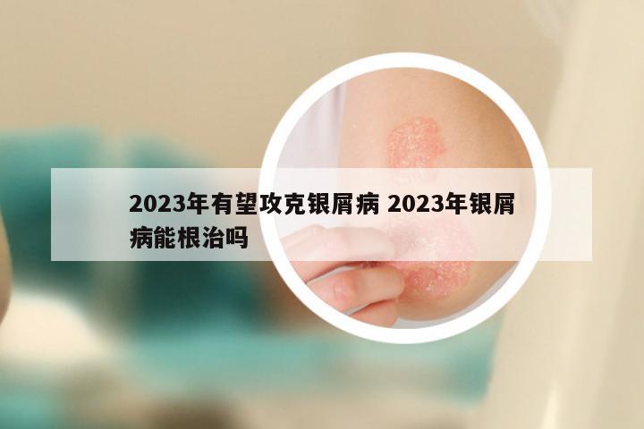 2023年有望攻克银屑病 2023年银屑病能根治吗