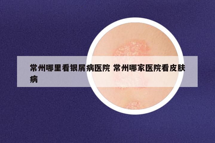 常州哪里看银屑病医院 常州哪家医院看皮肤病