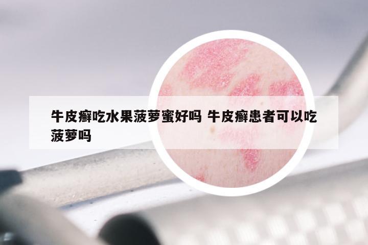 牛皮癣吃水果菠萝蜜好吗 牛皮癣患者可以吃菠萝吗