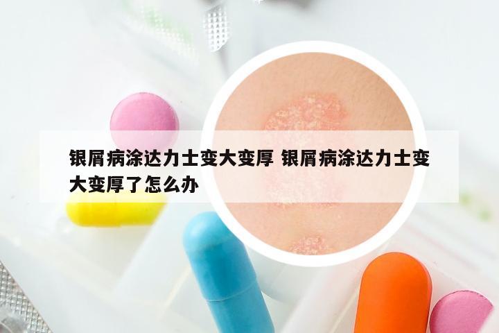 银屑病涂达力士变大变厚 银屑病涂达力士变大变厚了怎么办