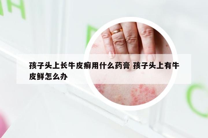 孩子头上长牛皮癣用什么药膏 孩子头上有牛皮鲜怎么办
