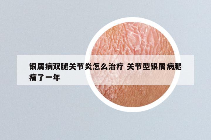 银屑病双腿关节炎怎么治疗 关节型银屑病腿痛了一年