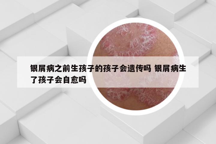 银屑病之前生孩子的孩子会遗传吗 银屑病生了孩子会自愈吗