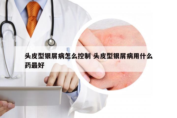 头皮型银屑病怎么控制 头皮型银屑病用什么药最好