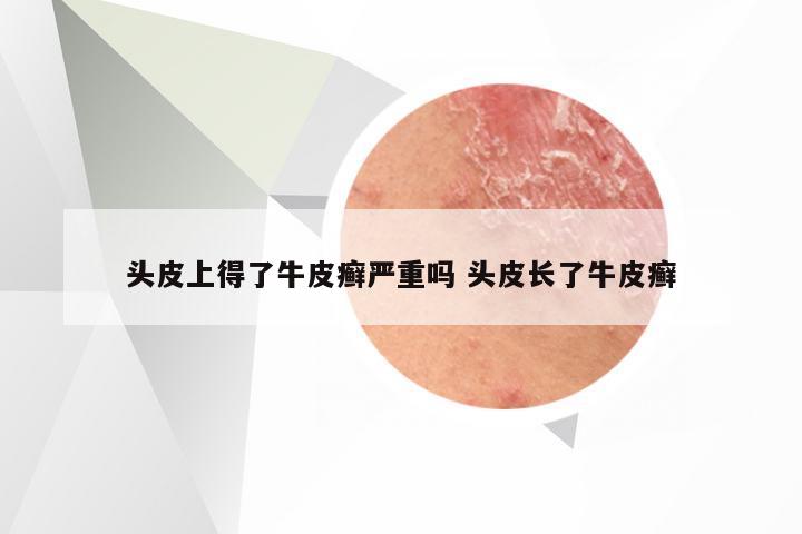 头皮上得了牛皮癣严重吗 头皮长了牛皮癣
