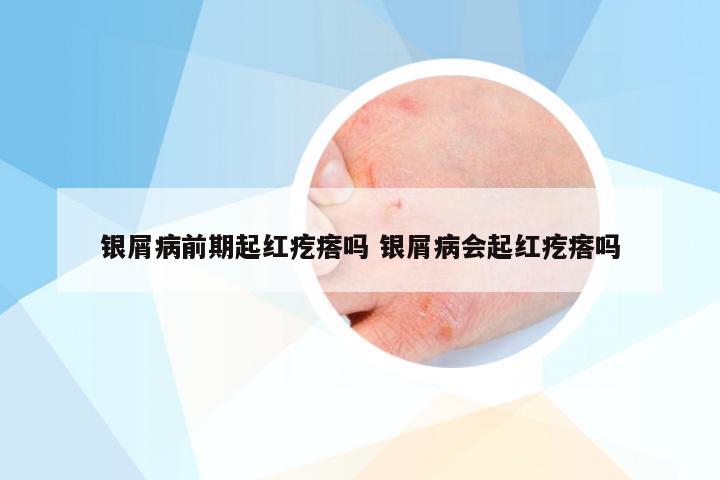 银屑病前期起红疙瘩吗 银屑病会起红疙瘩吗