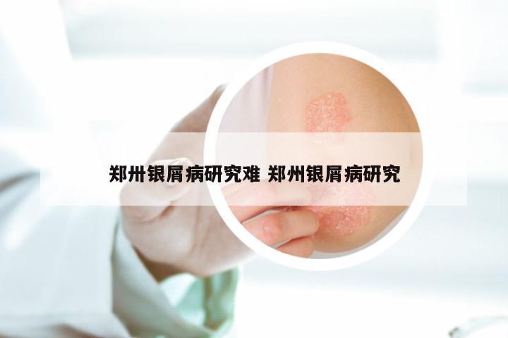 郑卅银屑病研究难 郑州银屑病研究