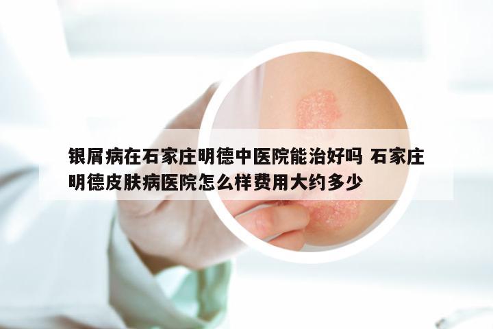 银屑病在石家庄明德中医院能治好吗 石家庄明德皮肤病医院怎么样费用大约多少
