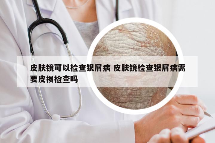 皮肤镜可以检查银屑病 皮肤镜检查银屑病需要皮损检查吗