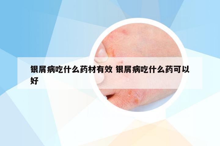 银屑病吃什么药材有效 银屑病吃什么药可以好