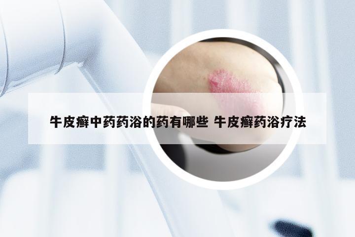 牛皮癣中药药浴的药有哪些 牛皮癣药浴疗法