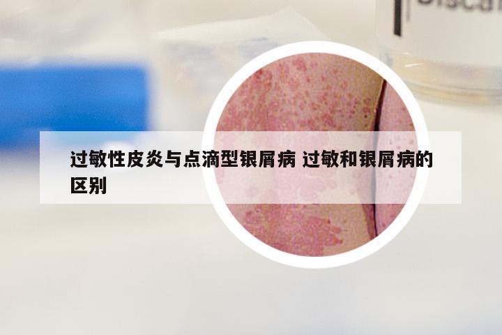 过敏性皮炎与点滴型银屑病 过敏和银屑病的区别