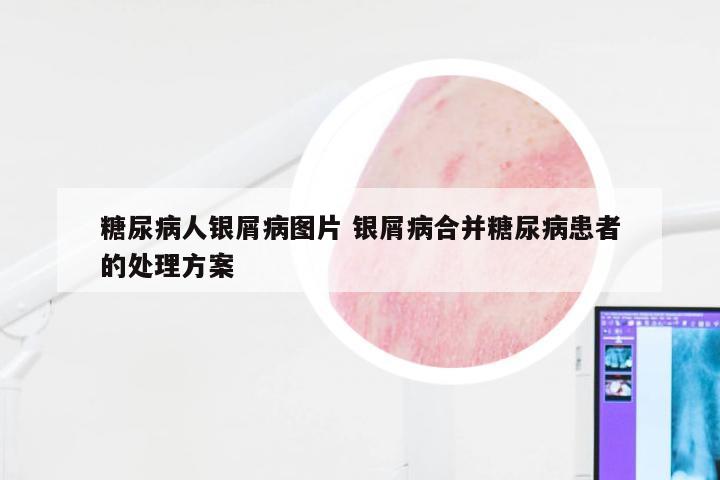 糖尿病人银屑病图片 银屑病合并糖尿病患者的处理方案