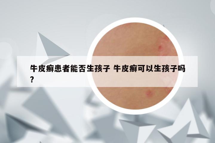 牛皮癣患者能否生孩子 牛皮癣可以生孩子吗?