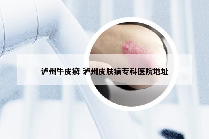 泸州牛皮癣 泸州皮肤病专科医院地址