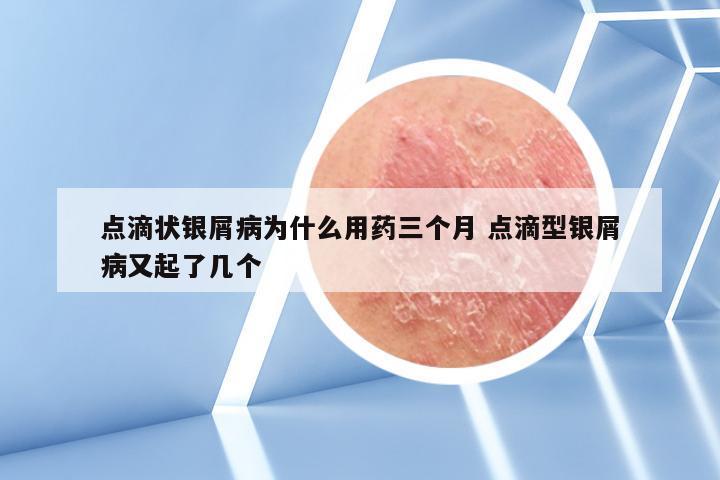 点滴状银屑病为什么用药三个月 点滴型银屑病又起了几个
