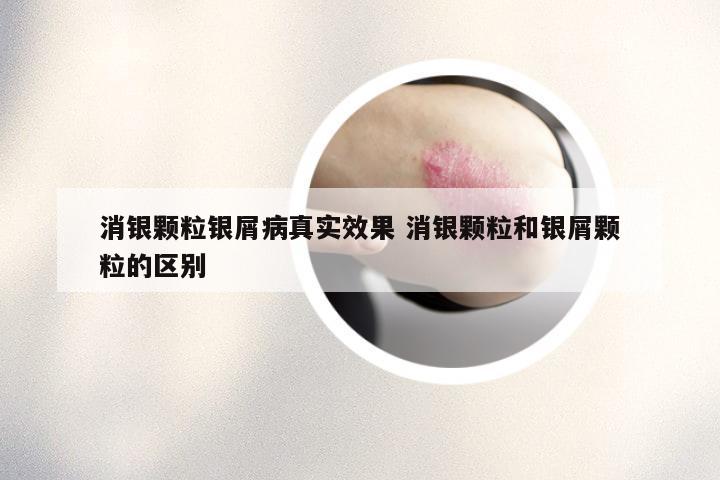 消银颗粒银屑病真实效果 消银颗粒和银屑颗粒的区别