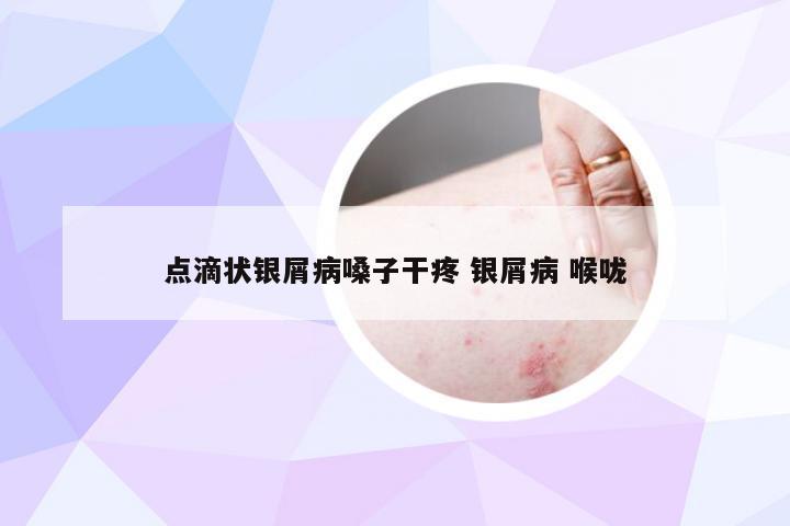 点滴状银屑病嗓子干疼 银屑病 喉咙