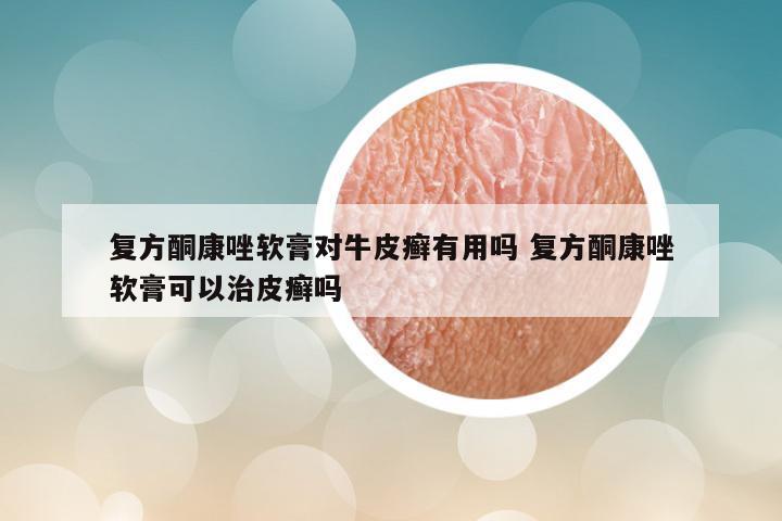 复方酮康唑软膏对牛皮癣有用吗 复方酮康唑软膏可以治皮癣吗
